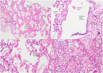 Fatal SARS in X-Linked Lymphoproliferative Disease Type 1: A Case Report
